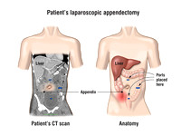 Appendectomy case